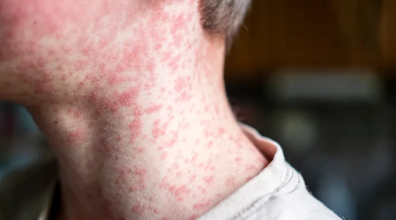 Measles Outbreak Maryland: Symptoms and More You Need To Know 