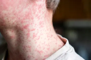 Measles Outbreak Maryland: Symptoms and More You Need To Know 