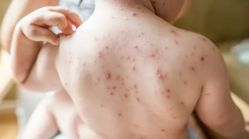 Nationwide measles cases now surpassing the number for all of last year